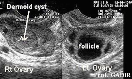 grapefruit size ovarian dermoid cyst