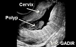 Endocervicalpolypnet