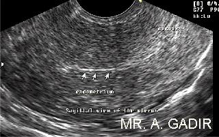 Endometriumduringmenses