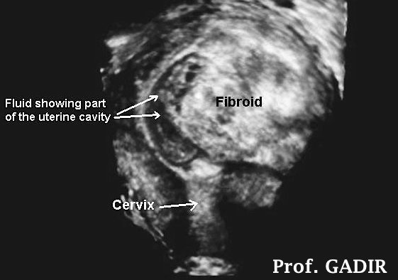 Fibroid_grade_2_rendered_view_of_fibroid_in_black_and_white_copy