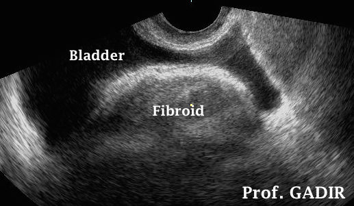 Fibroid_pushing_on_bladder_Anotated