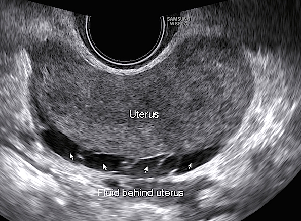 Fluid_behind_the_uterus