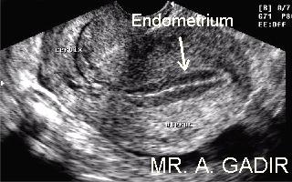 endometriummidcycle