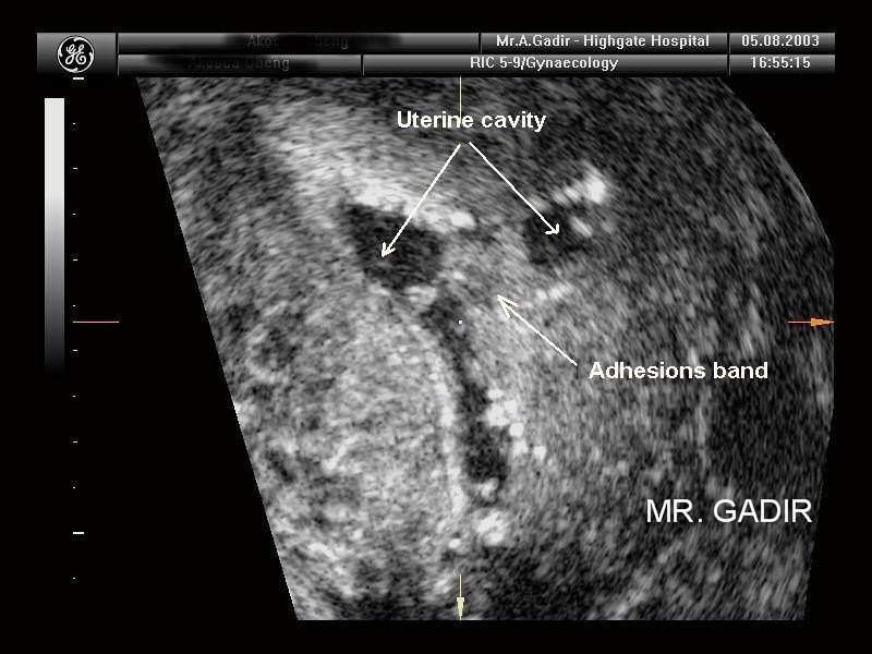 intrauterineAdhesions
