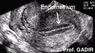midcycle_endometrium_anotated