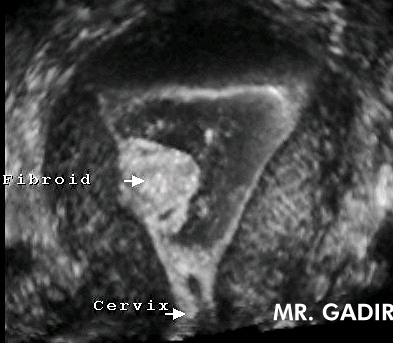 submucousfibroid
