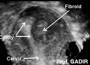 sumucous_fibroid_grade_0_funda_trimmedl_BW_for_the_net